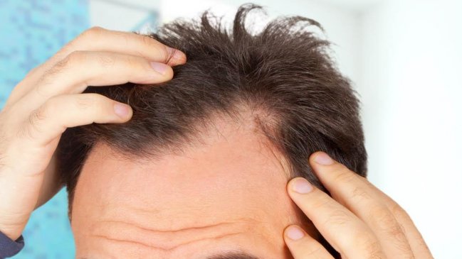 Compuesto promete revertir la caída del cabello y aparición de canas