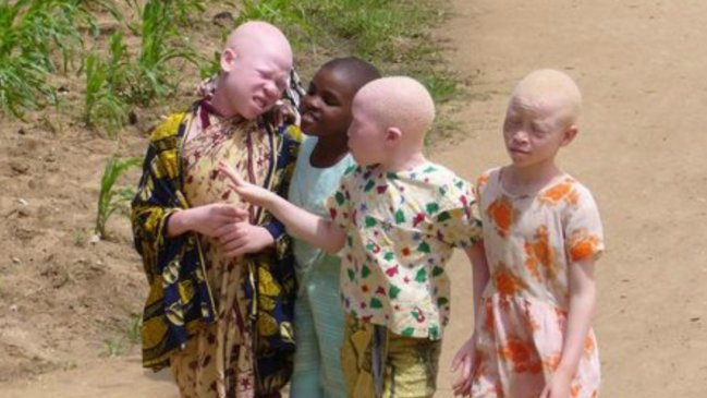  AI instó a países africanos a proteger a los albinos  