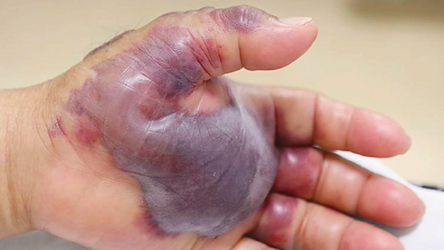 Hombre perdió su antebrazo tras comer mariscos crudos e infectarse