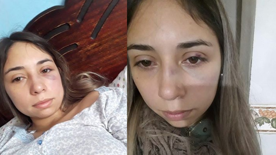 Joven denunció cobardes agresiones de su pareja: 