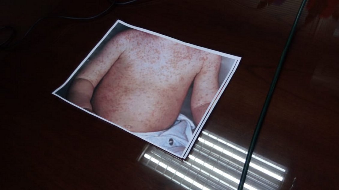 Subsecretaria de Salud: Posibilidades de que el sarampión se expanda son bastante pocas