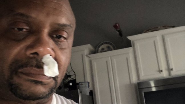 Creyó que tenía una alergia porque le goteaba la nariz, pero resultó ser líquido cerebral