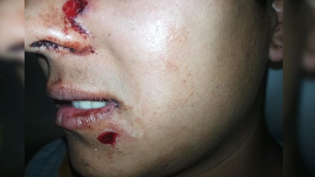 Padre Las Casas: Adolescente fue herido con perdigones en el rostro durante incidentes
