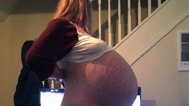 Pensó que estaba embarazada pero tenía un quiste de 26 kilos