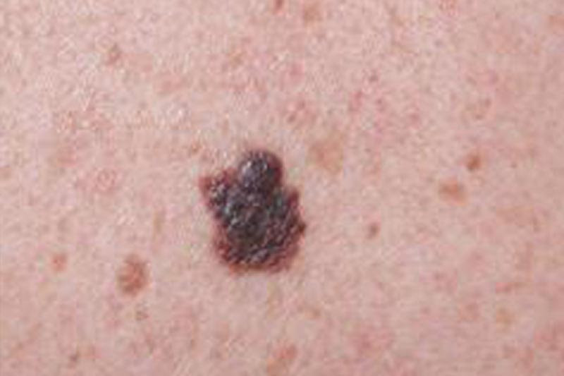 Desarrollan campaña que busca la prevención efectiva del cáncer a la piel en el Maule