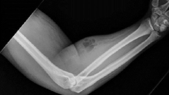 Hombre se inyectaba semen en el brazo para tratar dolores y acabó hospitalizado