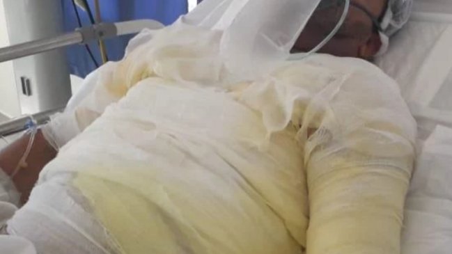 Mujer roció con alcohol a su ex pareja y le prendió fuego