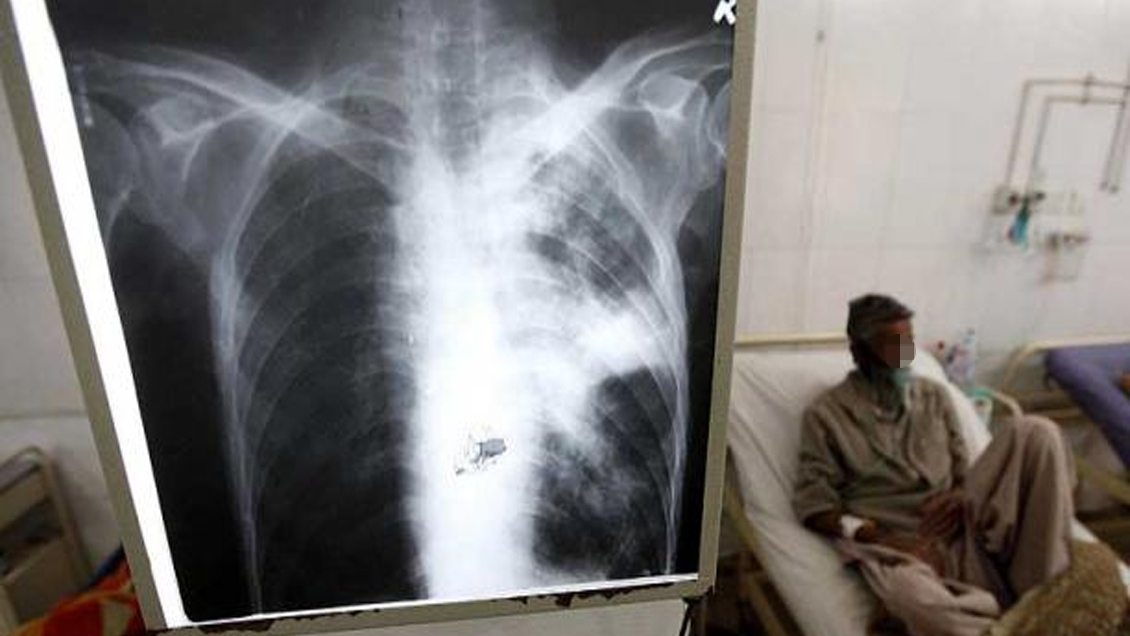 La tuberculosis en Europa se reduce un 4,7% cada año