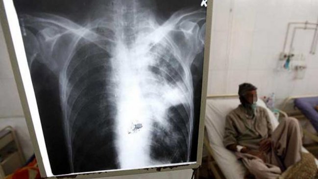 La tuberculosis en Europa se reduce un 4,7% cada año