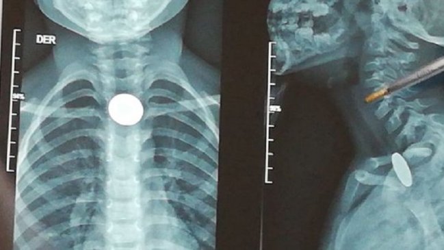 Niño se tragó una moneda y lleva una semana sin que se la puedan sacar