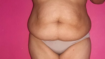   Quiénes pueden postular a cirugía gratuita de 