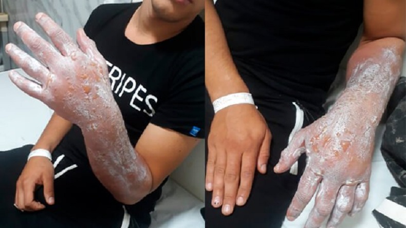 Joven casi pierde el brazo por culpa de una apuesta: Lo metió en hielo para ganar