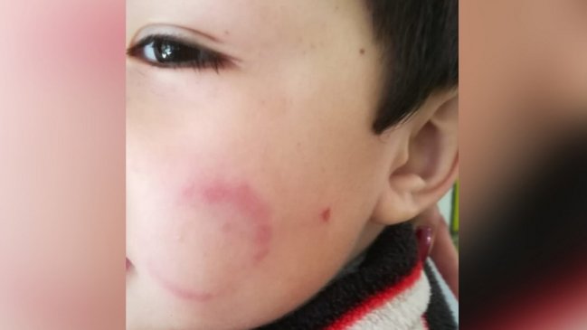 Joven madre recibió a su hijo mordido y arañado desde un jardín infantil Junji