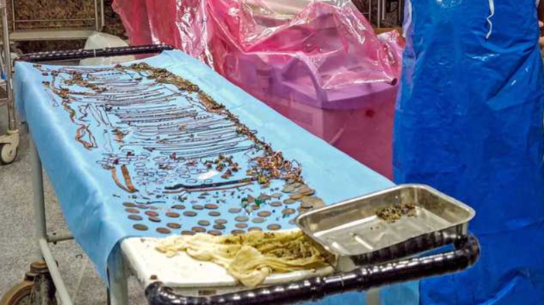 Médicos sacaron joyas y oro del estómago de una mujer