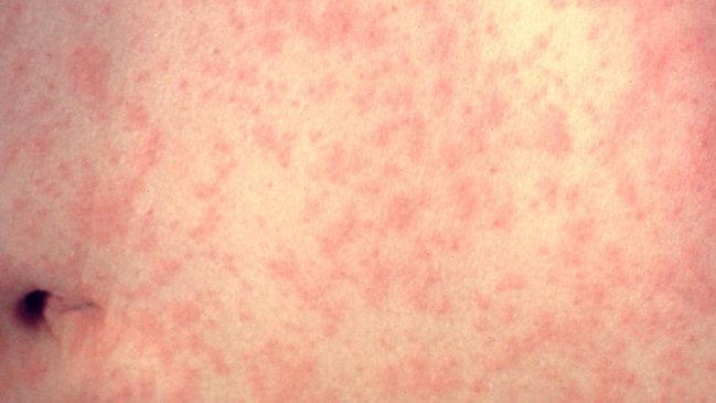 Madre antivacunas contagió a sus cinco hijos de sarampión