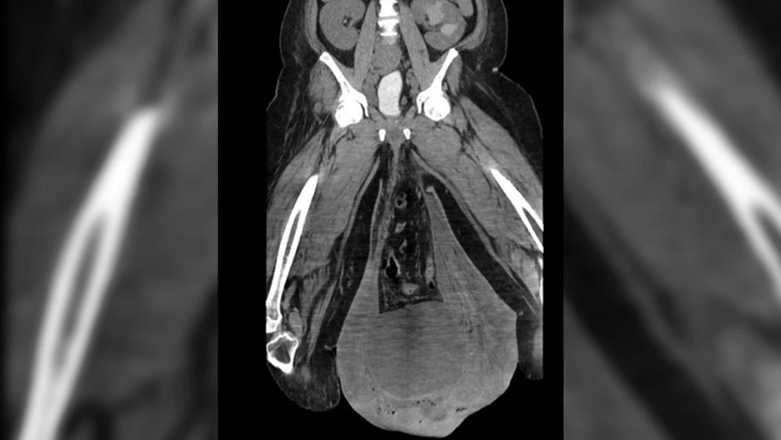 Hombre sufrió grave inflamación de sus testículos: Tenían el tamaño de una pelota de fútbol