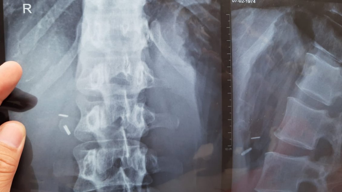 Paciente denuncia supuesta negligencia médica del Hospital de Talca