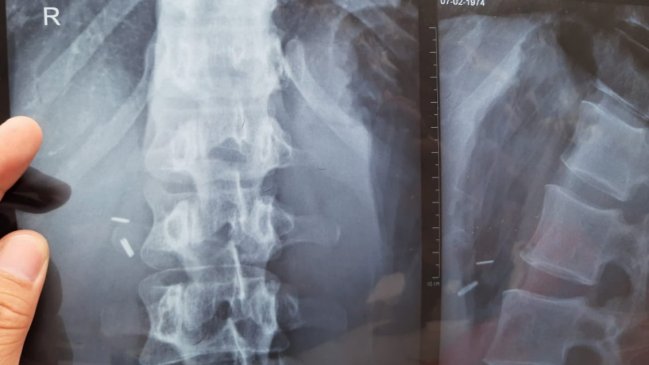 Paciente denuncia supuesta negligencia médica del Hospital de Talca