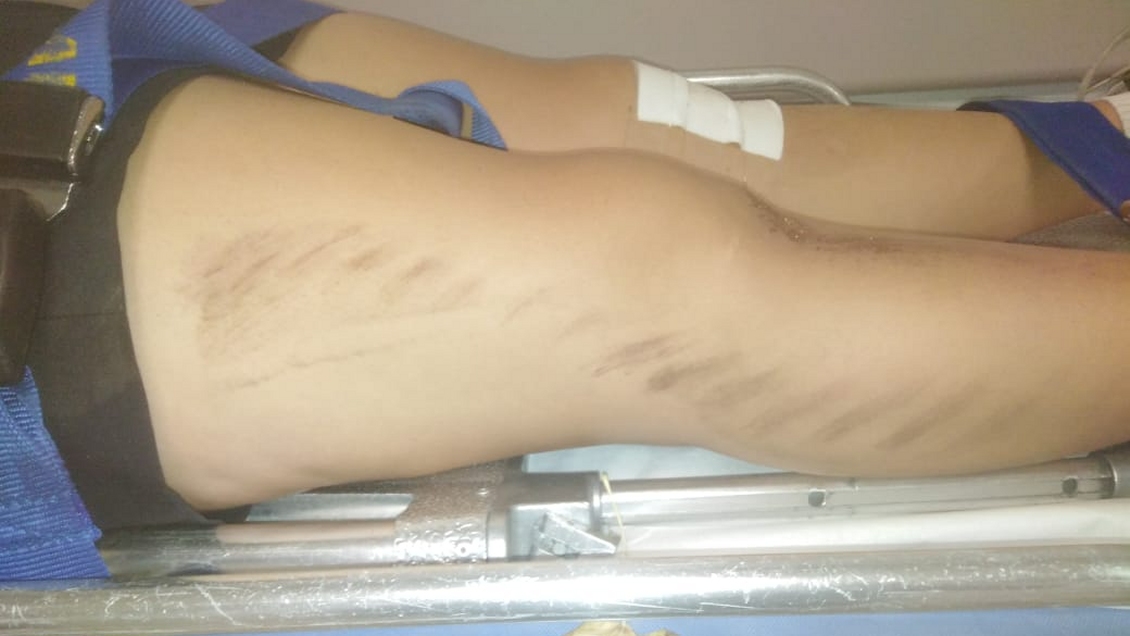 Estudiante quedó con policontusiones tras ser atropellada por motorista de Carabineros