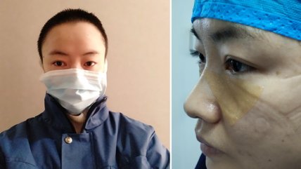   Trabajadoras chinas mostraron las marcas tras combatir al coronavirus 