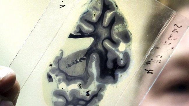 Científicos avanzan en técnica para detectar el Alzheimer hasta 20 años antes de que aparezcan síntomas