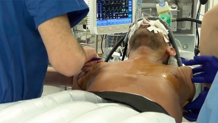   Primer paciente trasplantado de brazos y hombros del mundo evoluciona favorablemente 