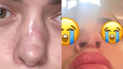  Estrella de reality perderá su nariz tras cirugías fallidas  