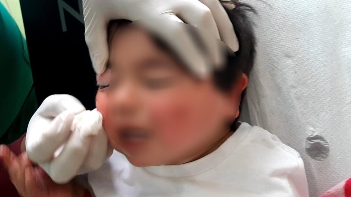 Guagua quedó con un ojo sellado tras atenderse en Cesfam de Tirúa