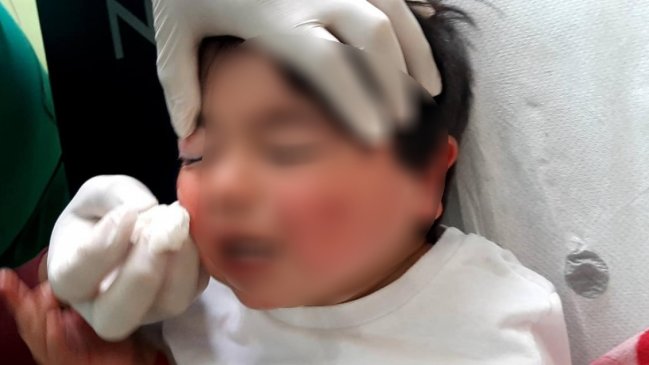 Guagua quedó con un ojo sellado tras atenderse en Cesfam de Tirúa