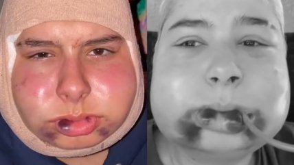  El antes y después de tiktoker tras cirugía de mandíbula  