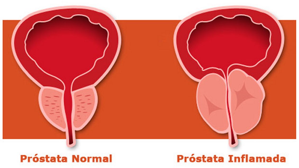 Alertan sobre impacto del cáncer de próstata en hombres chilenos