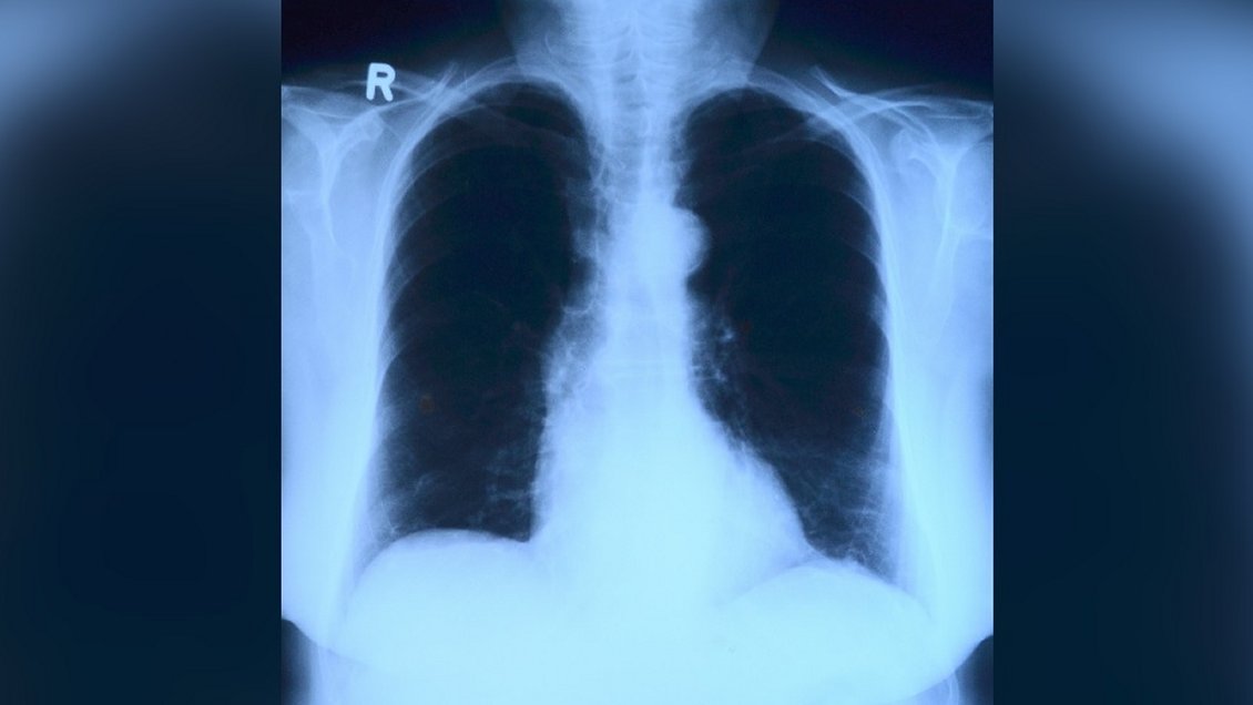 Estudio PUCV demostró que rayos X más inteligencia artificial pueden diagnosticar el Covid