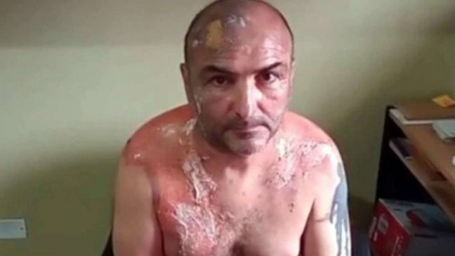 Hombre acusa a ex esposa de quemarlo con agua hirviendo: 
