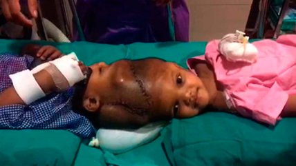   Exitosa primera separación de siameses en Jordania 