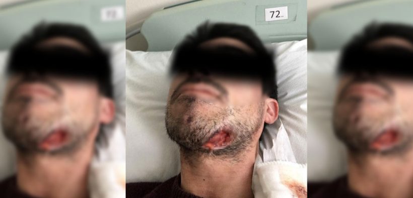 Movilh denuncia ataque homofóbico: Agresor mordió en el mentón a una de las víctimas