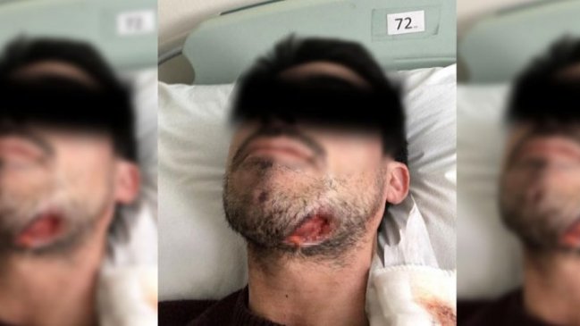 Movilh denuncia ataque homofóbico: Agresor mordió en el mentón a una de las víctimas