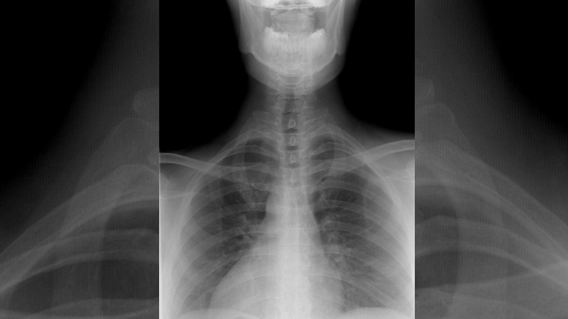 Tecnólogo médico fue condenado por abusar a adolescente durante toma de radiografía