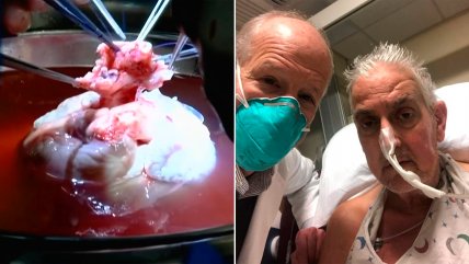  Hito para la medicina: Así fue el histórico trasplante de corazón de cerdo a un hombre de 57 años 
