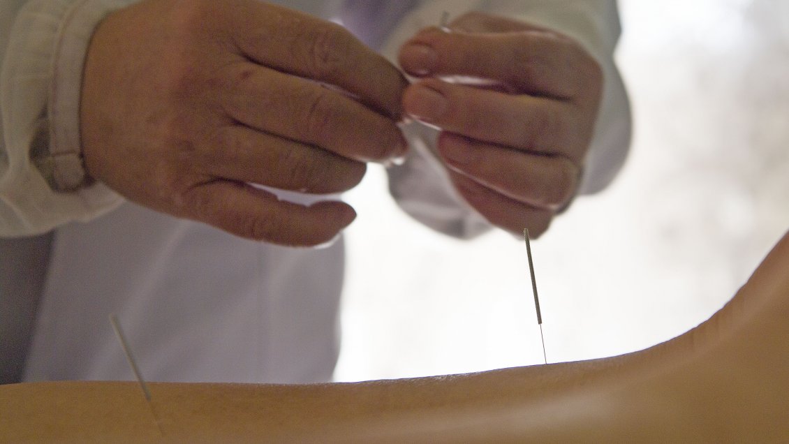 China introduce la acupuntura en su protocolo actualizado contra el covid