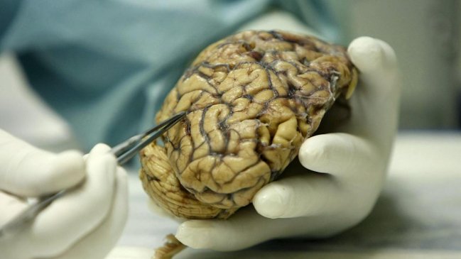 Avanza la lucha contra el Alzheimer: identifican 75 regiones genómicas asociadas con la enfermedad