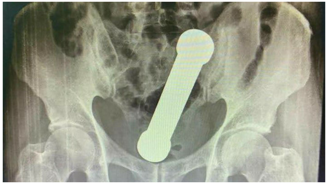 Encuentran una mancuerna de dos kilos en el recto de un hombre con dolor de estómago