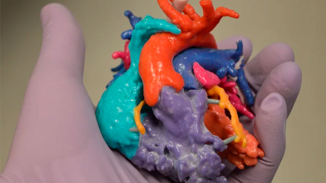 La impresión 3D impulsa las cirugías cardiovascualares en el Hospital de Temuco