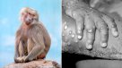 ¿Qué es la viruela del mono? La enfermedad que enciende las alarmas en Europa y EEUU