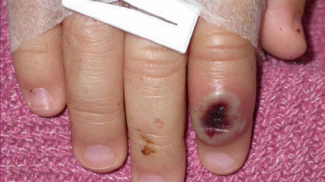 La ONU advierte sobre discursos racistas y homófobos ante la viruela del mono