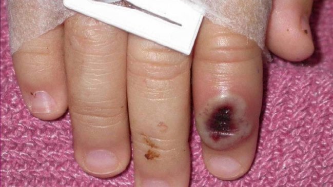 La ONU advierte sobre discursos racistas y homófobos ante la viruela del mono