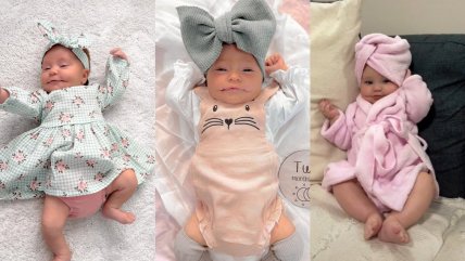  Bebé con síndrome de la 