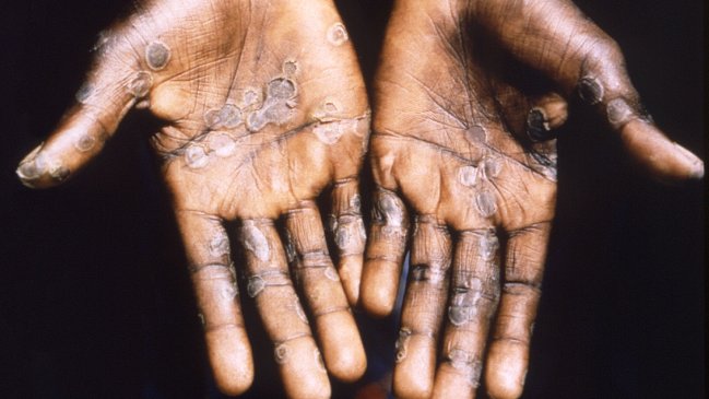 EEUU cree que ya podría haber transmisión comunitaria de la viruela del mono