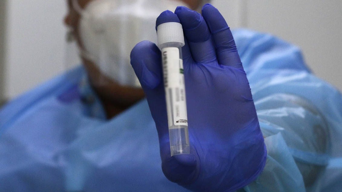 Minsal declaró alerta sanitaria en Chile por la viruela del mono