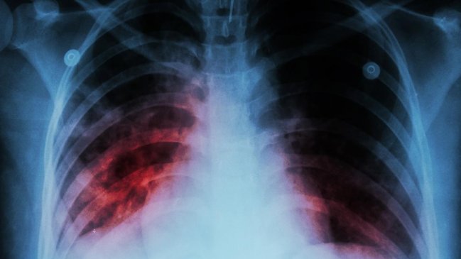  Casi 50 trabajadores de la salud se infectaron de tuberculosis en Venezuela  