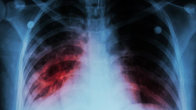 Casi 50 trabajadores de la salud se infectaron de tuberculosis en Venezuela